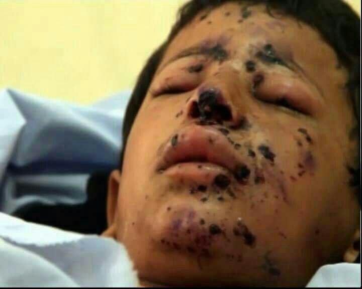 ۲۰۰۰ کودک از آغاز جنگ یمن کشته و زخمی شده‌اند